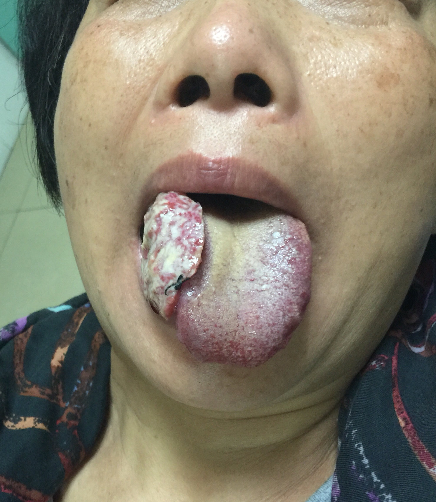 舌癌的症状图片舌头图片