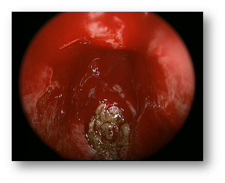 鼻窦炎白色分泌物图片图片