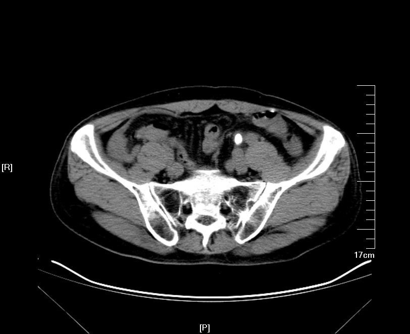 输尿管结石ct图片
