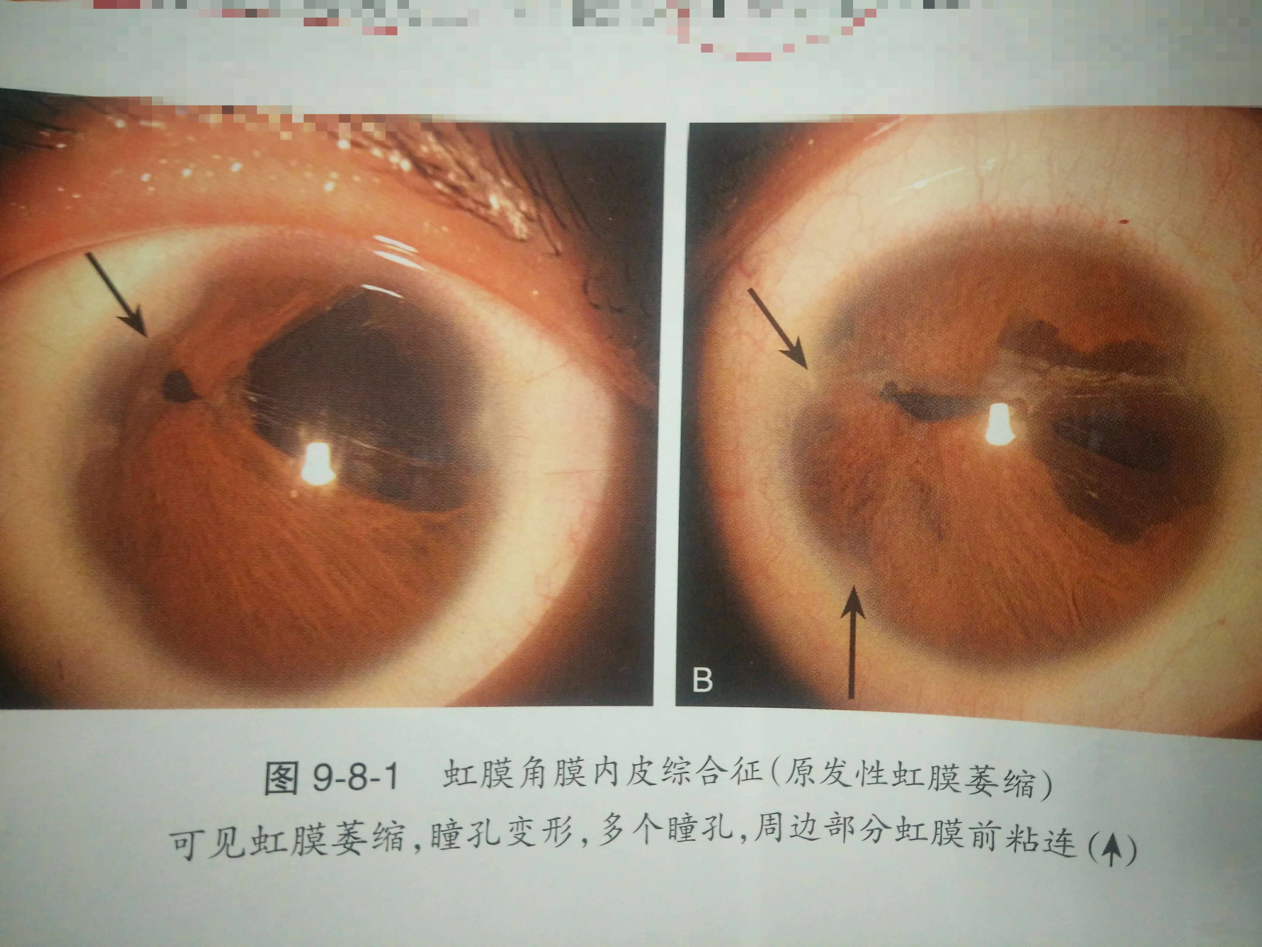 虹膜萎缩图片