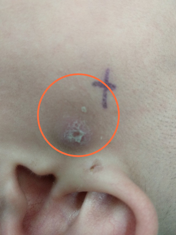 儿童耳瘘手术后图片图片