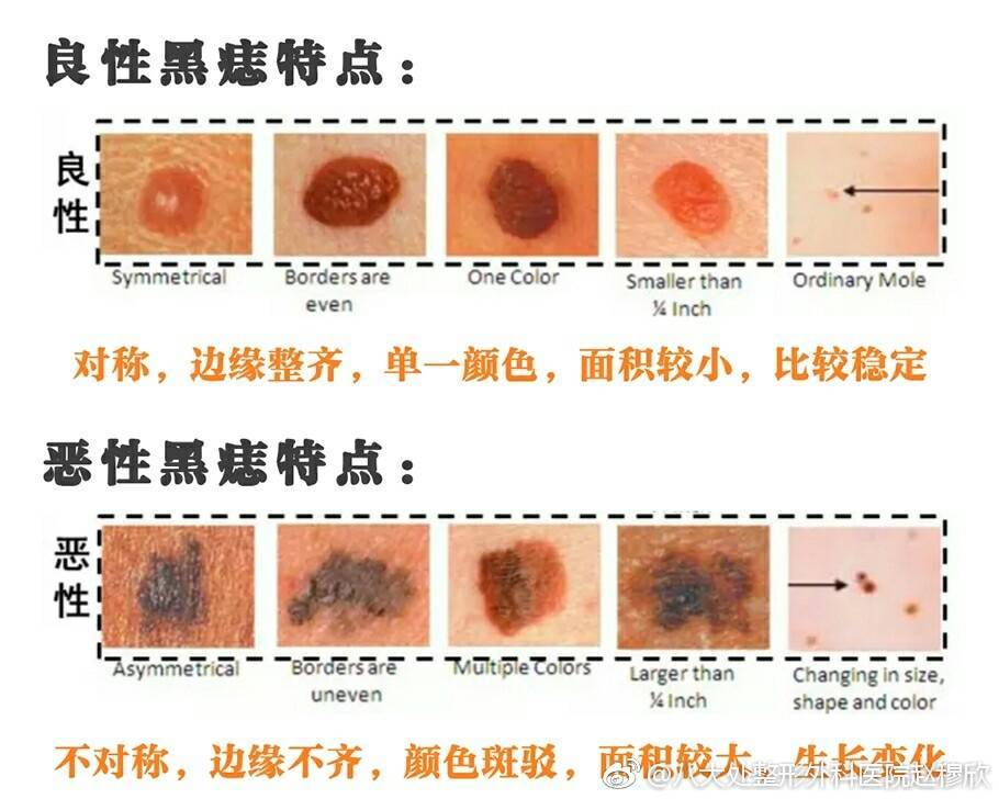 边缘不规则的黑痣图解图片