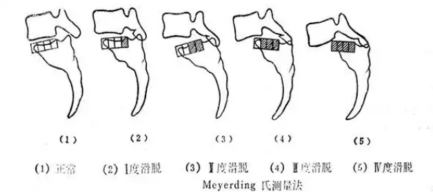 腰椎滑脱有哪些症状?应该怎样诊断和治疗呢?