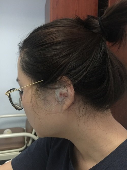中耳炎手术切口刀疤图图片