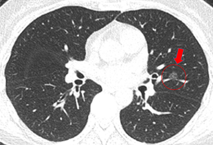 早期肺癌ct图报告单图片