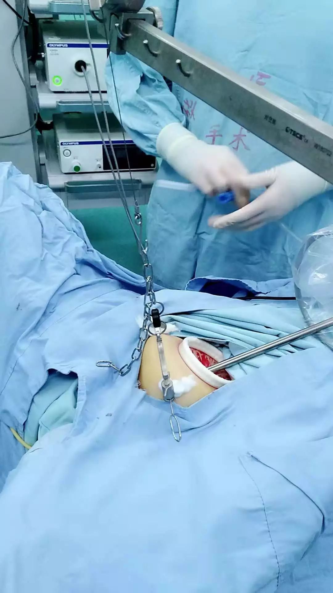 乳房手术全过程 悬吊图片