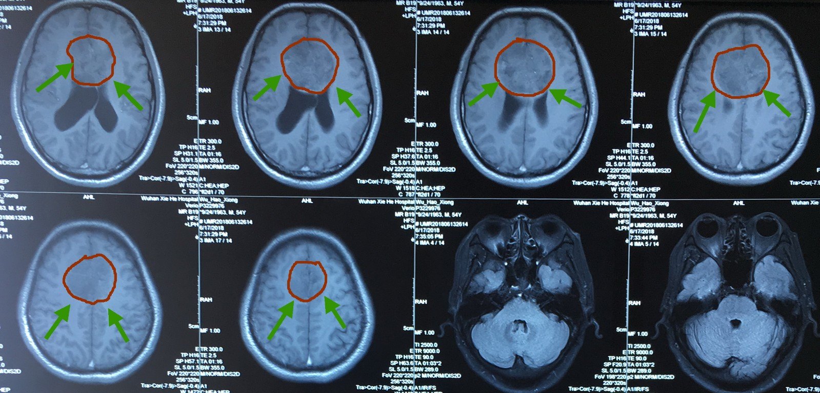 脑肿瘤核磁报告单图片图片