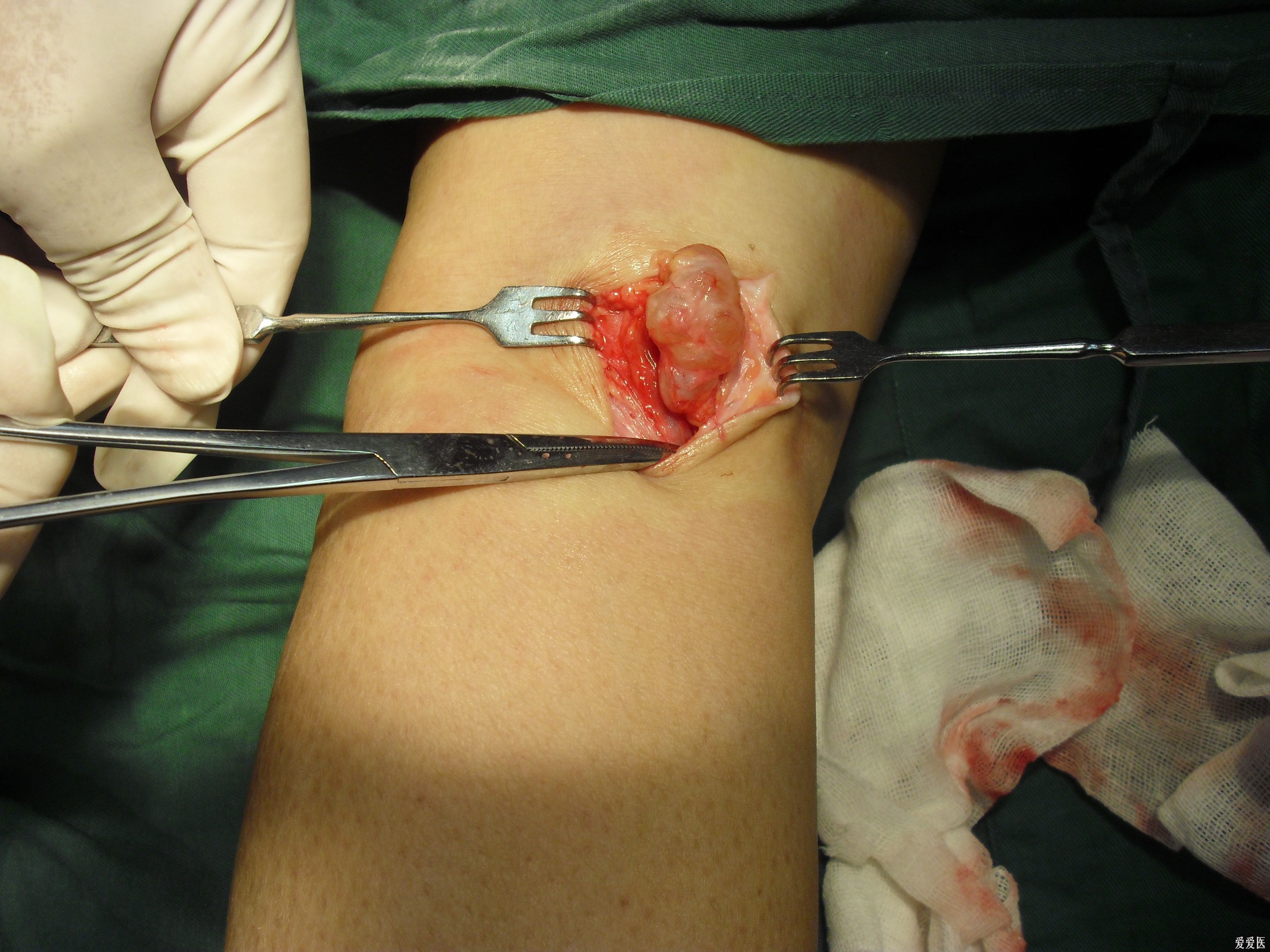 膝关节镜微创切除腘窝囊肿