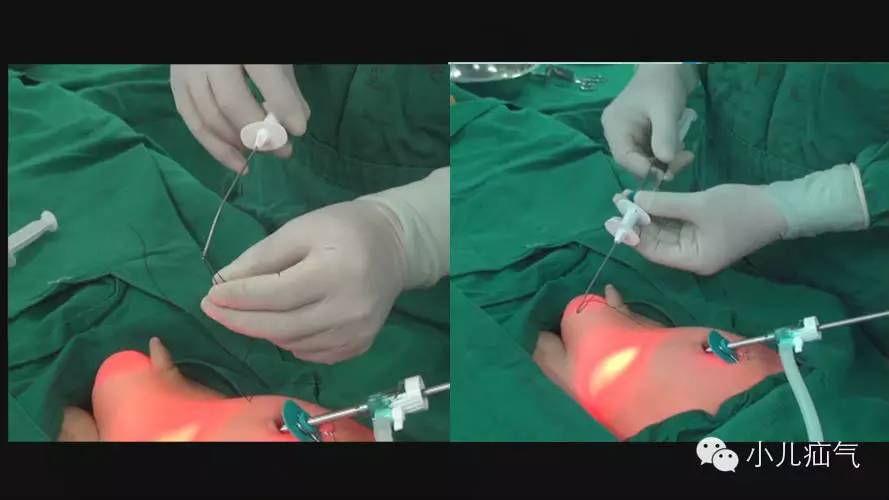 单孔腹腔镜双钩疝针注水分离左腹股沟疝内环结扎术手术演示转载