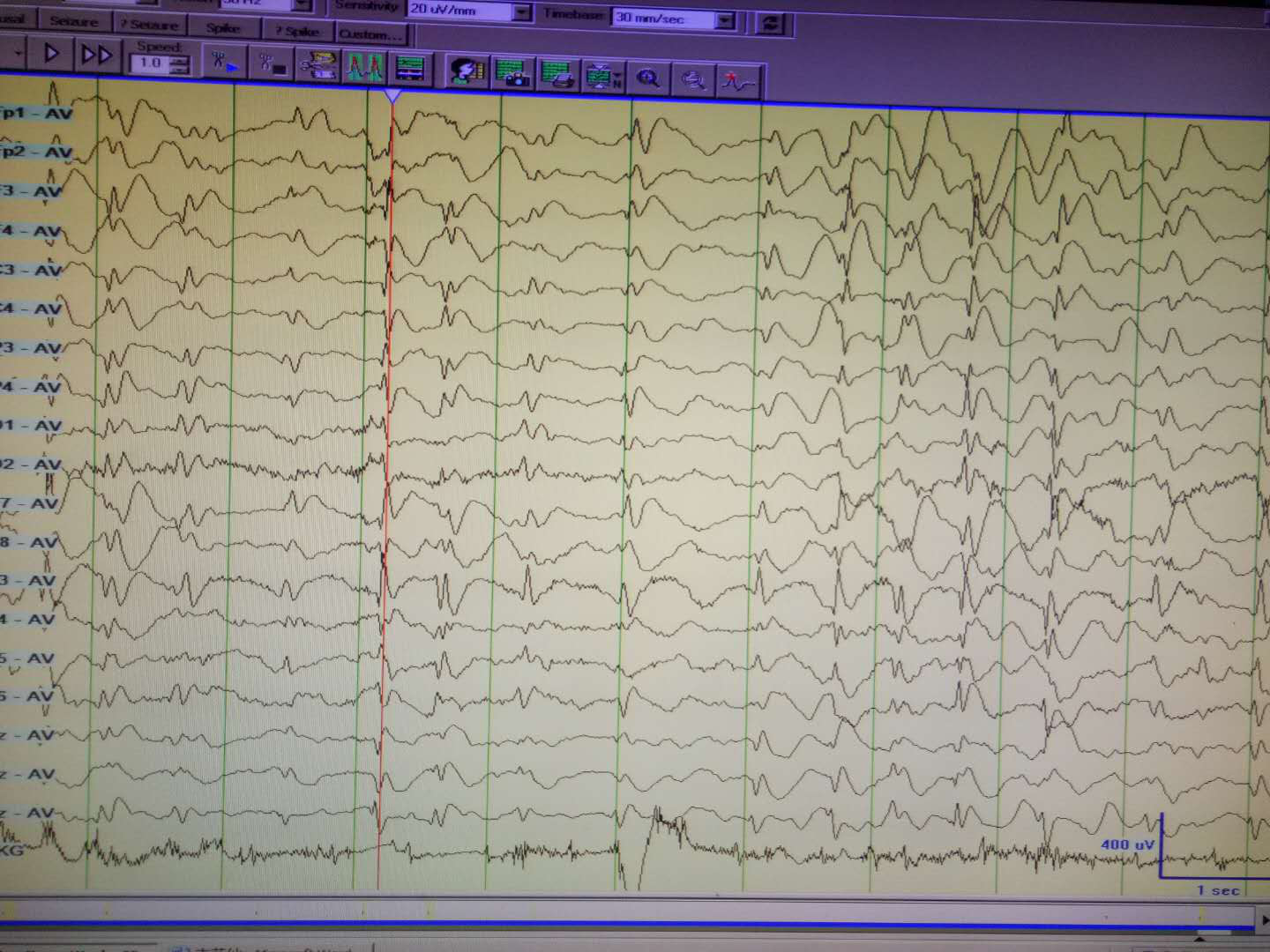 脑电图尖波图片图片