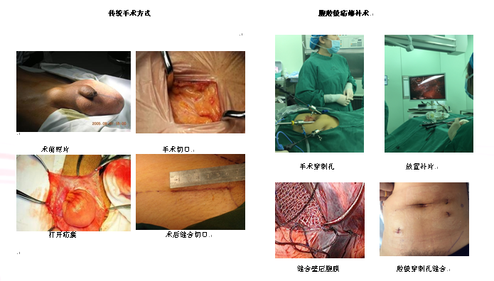 修補下腹部的腹壁缺損,疝修補術與傳統手術方式相比,有其不可比擬的