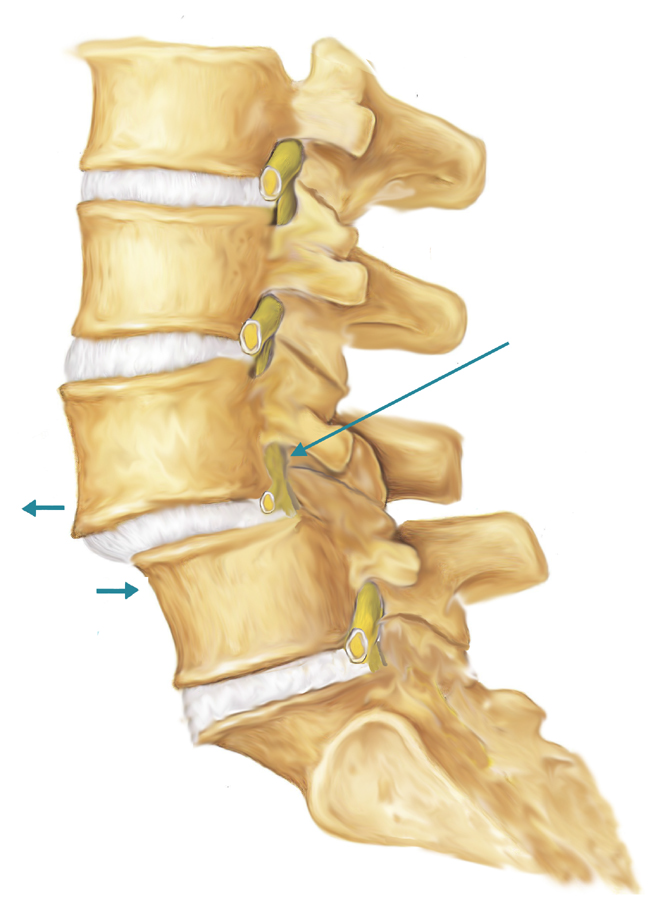 腰椎弓峡部解剖图图片