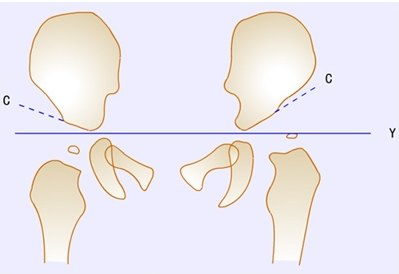 诊断髋关节发育不良的常用角度