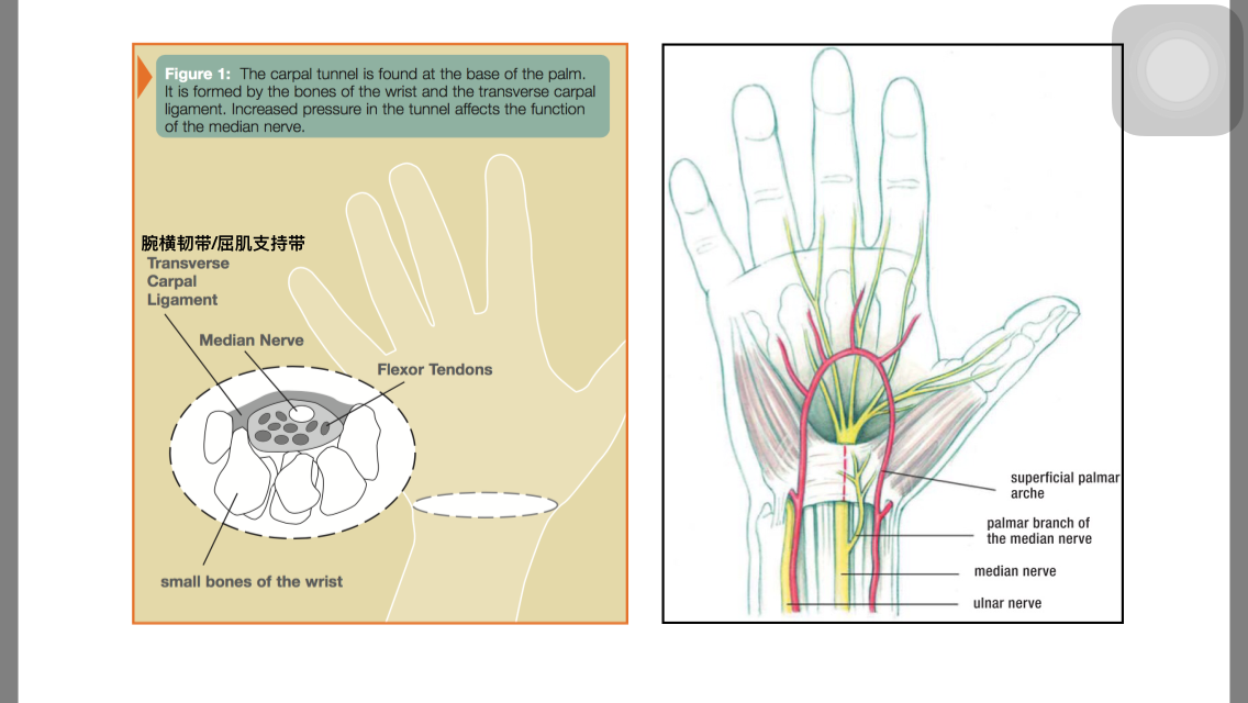 腕管综合征的诊治