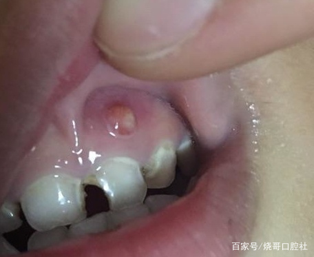 大牙根部牙龈肿痛图片图片