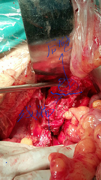 术前的盆腔ct三下图为卵巢术后复发,再次将阴道残端根治切除二