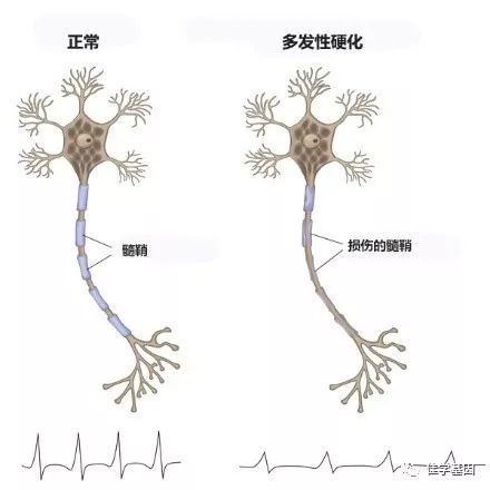 多发性硬化基因检测是否可以找到致病基因并确诊吗