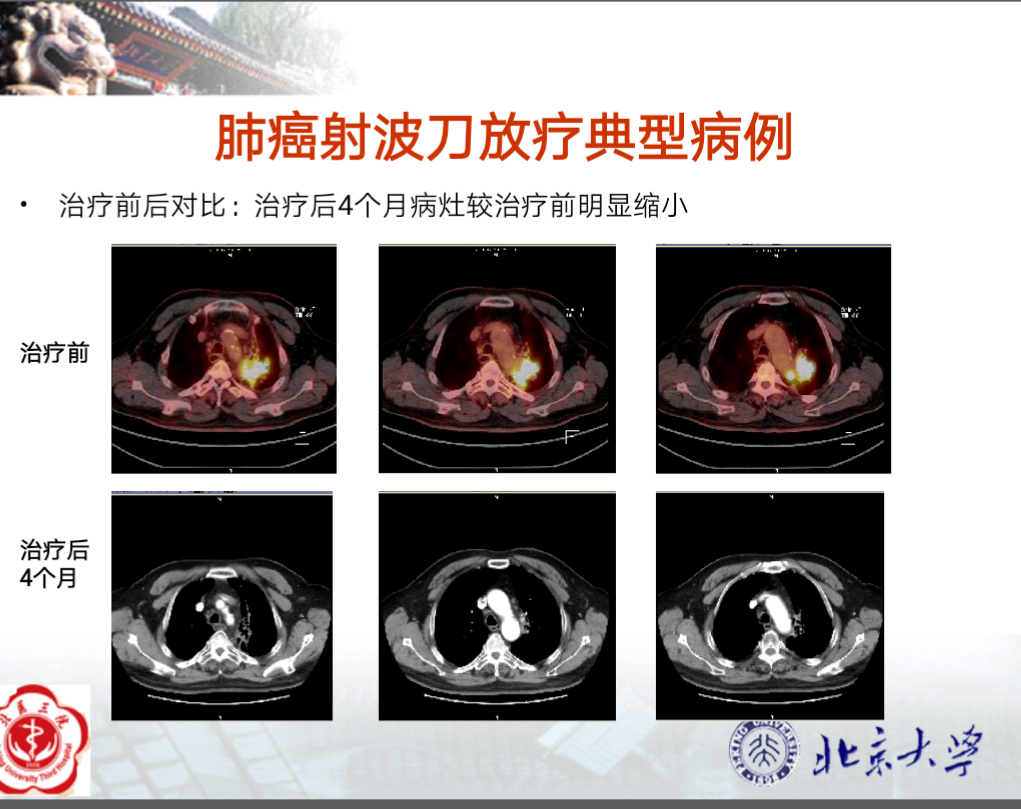 射波刀放療治療肺癌臨床療效分享_提示