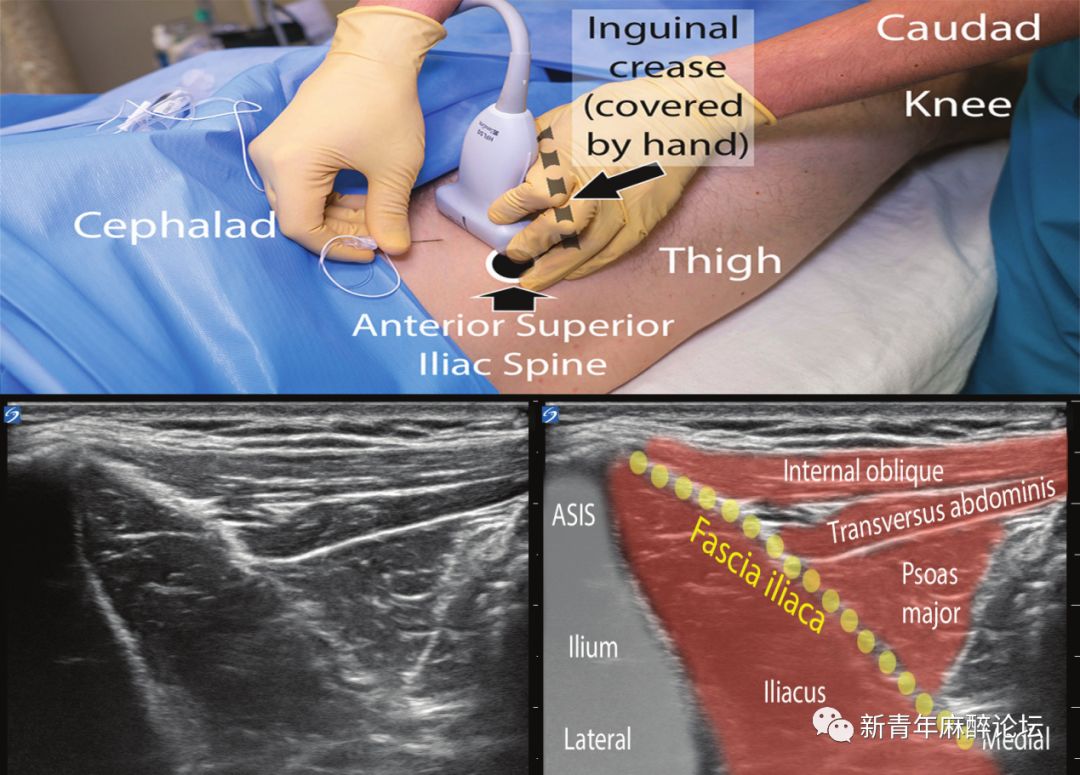 髂筋膜阻滞超声图图片