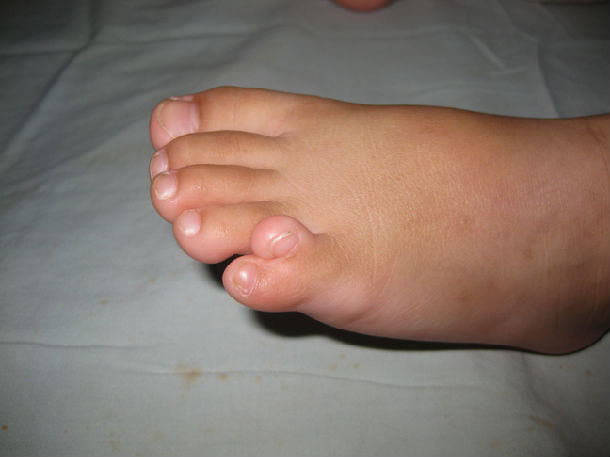 足趾畸形有哪几种图片图片