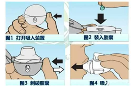 吸嘴向下;低頭吸入;常見錯誤:3)噻託溴銨粉吸入劑(思力華)2)信必可都