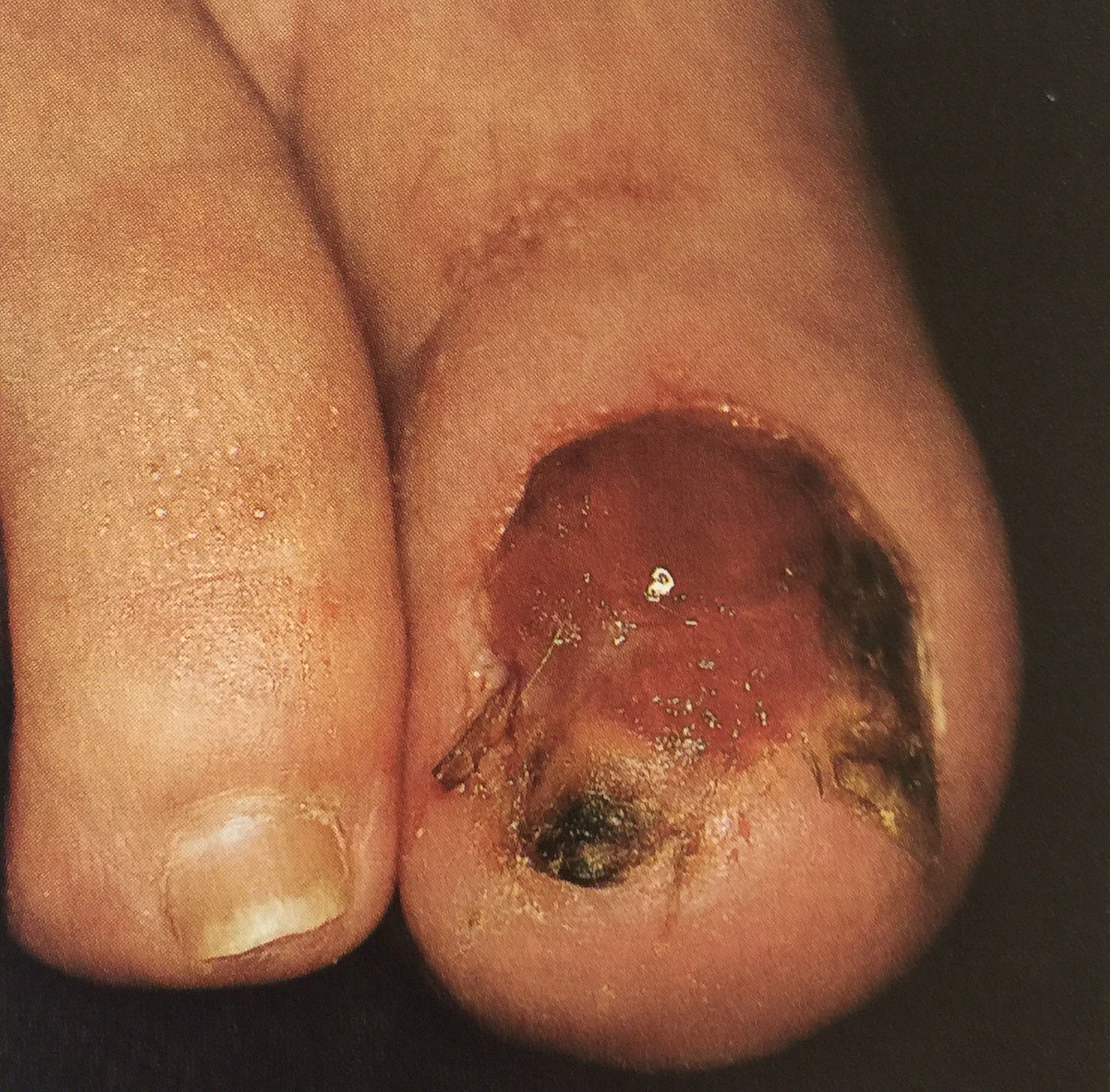 指甲下的黑色素瘤图片图片