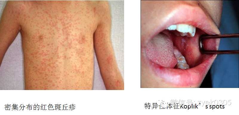 斑疹丘疹斑丘疹的区别图片