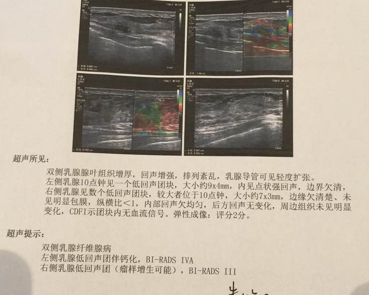 典型病例1 双侧乳腺结节bi