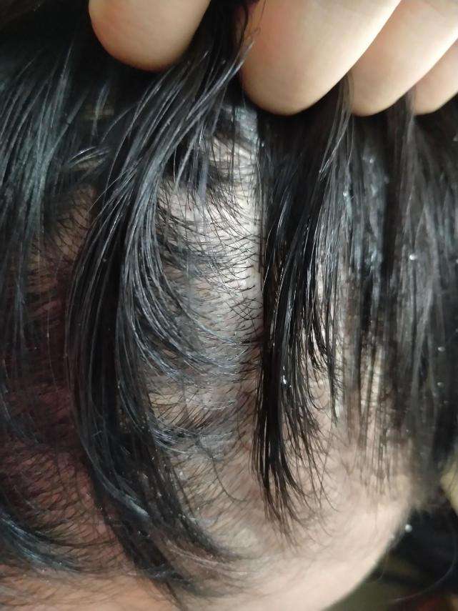头发上长的白色管状物多半为卵形糠秕孢子菌清除用2招