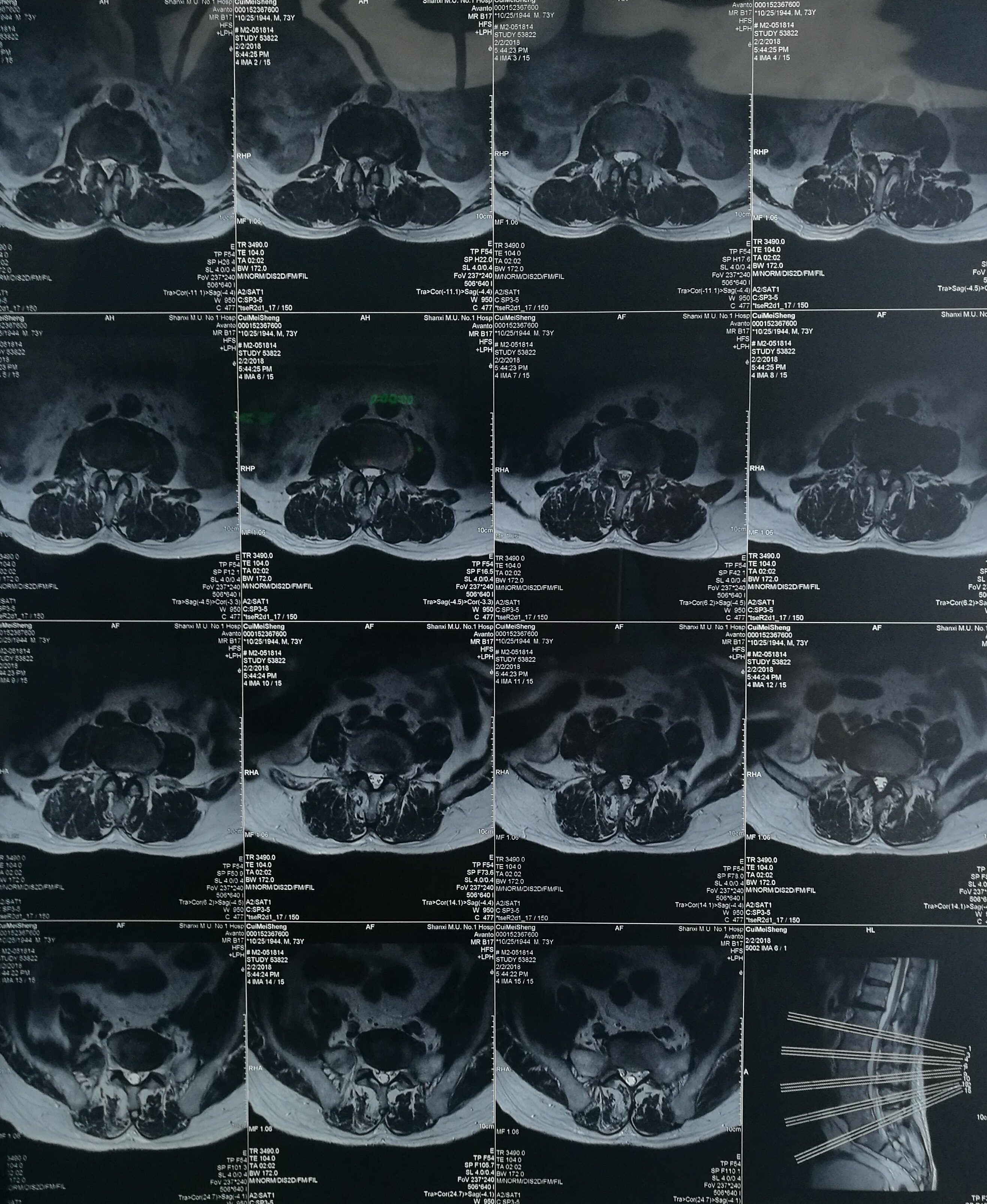 术前腰椎mri示:腰4/5间盘突出合并腰椎管狭窄