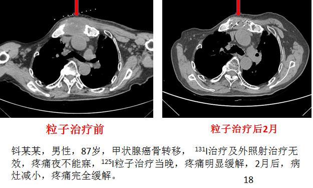 甲狀腺癌骨轉移了碘治療無效怎麼辦