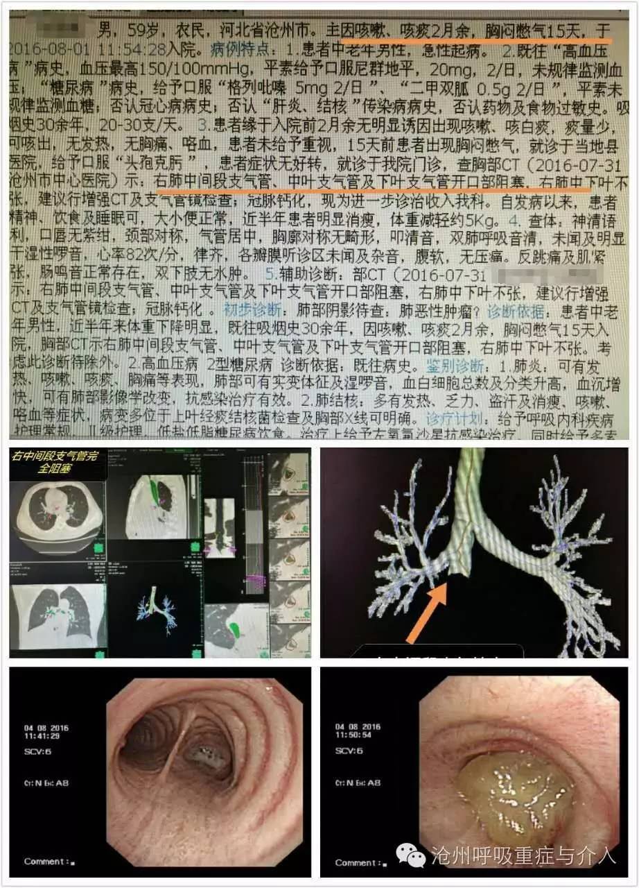 气管癌图片