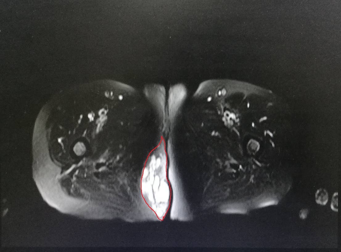 急性肛门囊肿图片图片