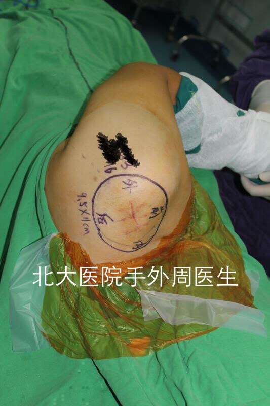 脂肪瘤 纖維瘤 血管瘤?軟組織惡性腫瘤手術治療_手術