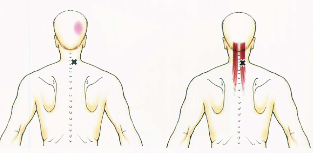 頸源性頭痛相關肌肉分析彙總肌肉致頭痛肌肉治頭痛