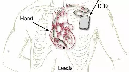 心脏起搏器装在哪里图片