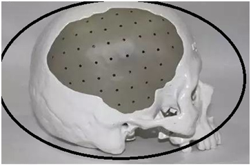 peek颅骨材料图片