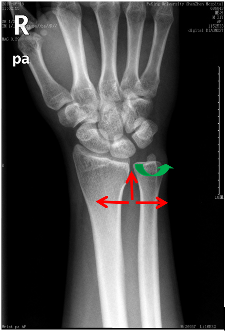 最终这位病友的诊断为:右腕下尺桡关节不稳定,右侧tfcc损伤
