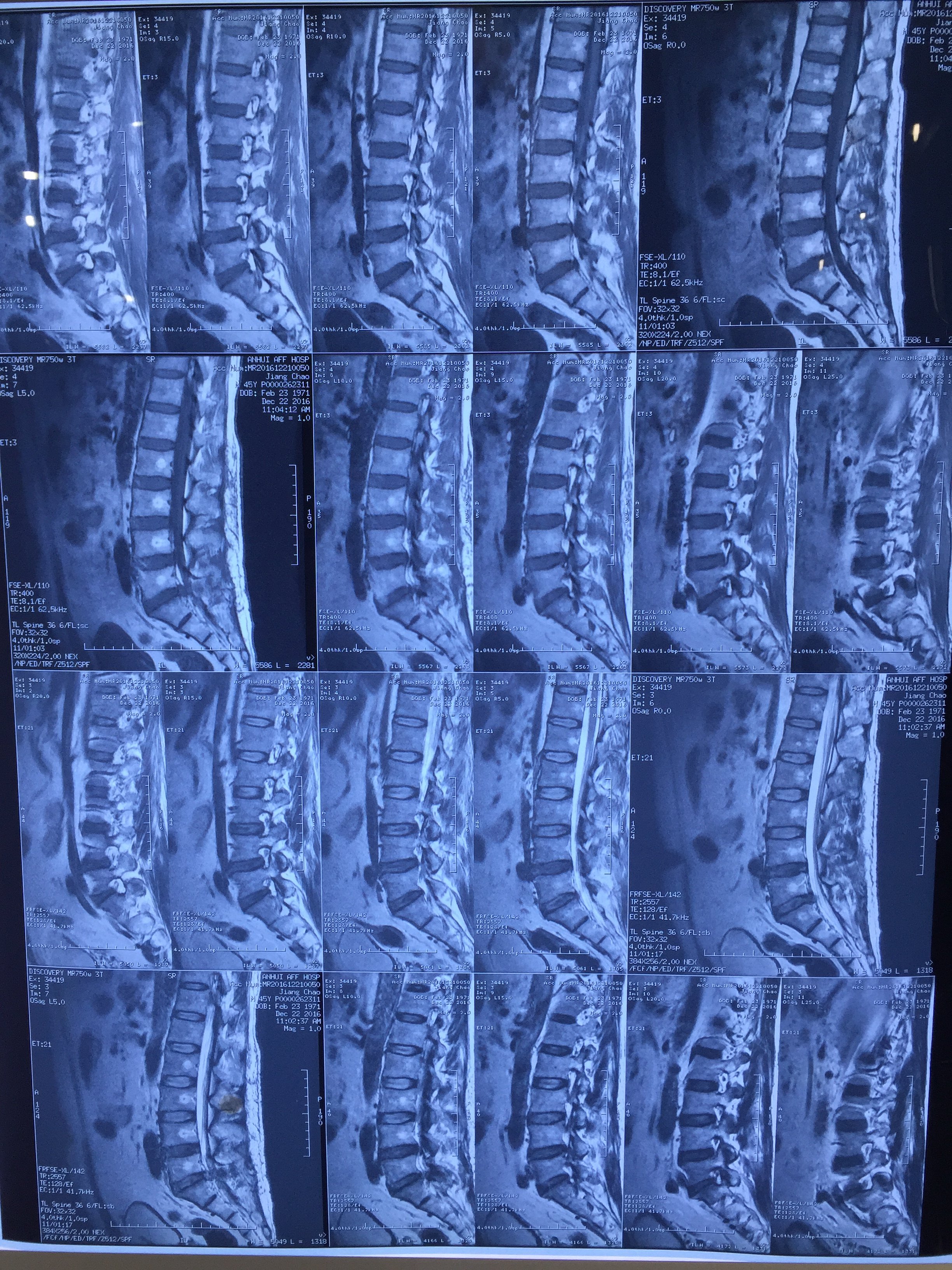 腰5骶1椎间盘突出髓核偏左侧突出,引起严重左腿疼痛