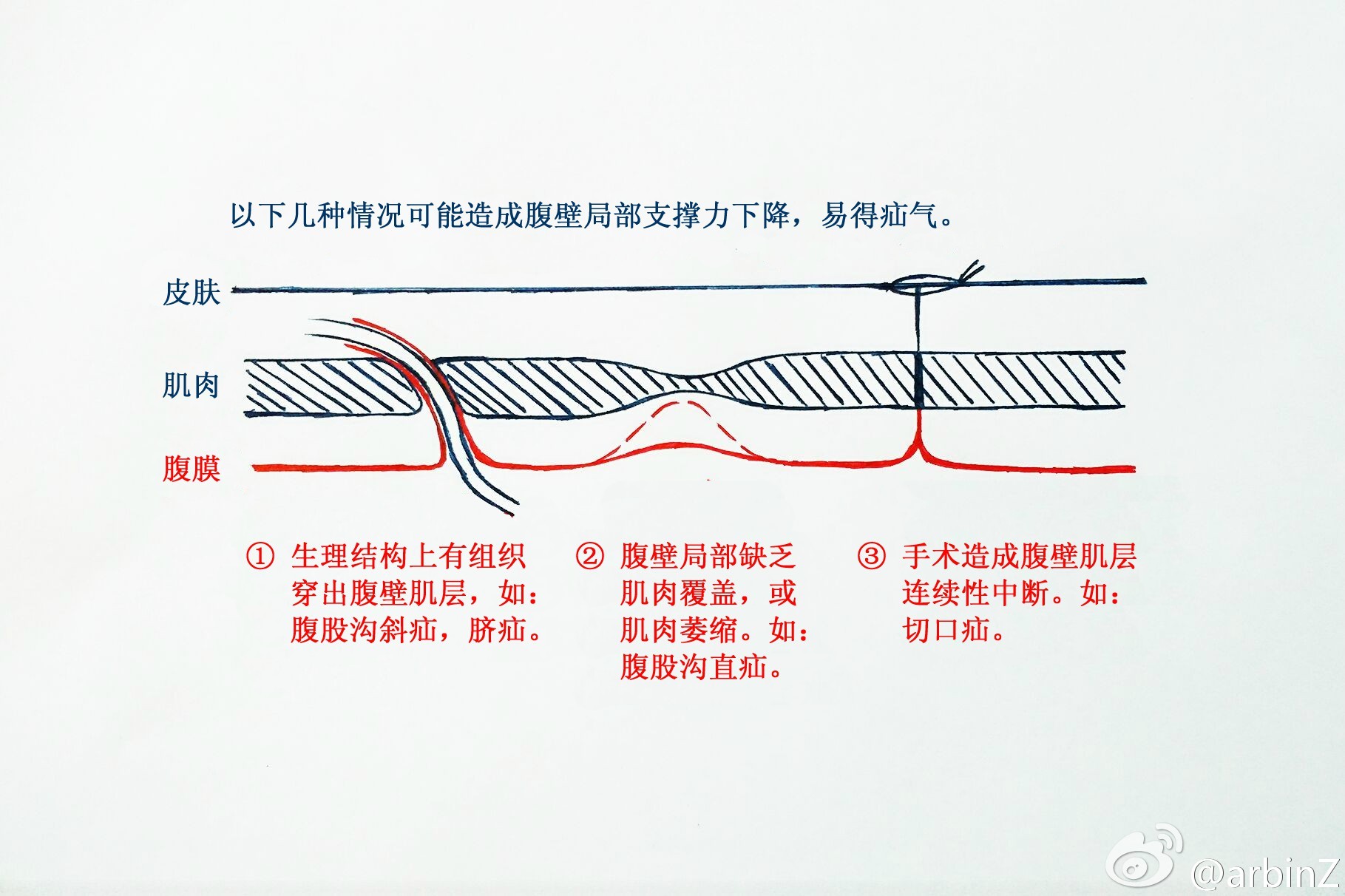 為什麼會得疝氣?這裡就不得不提腹壁的層次.