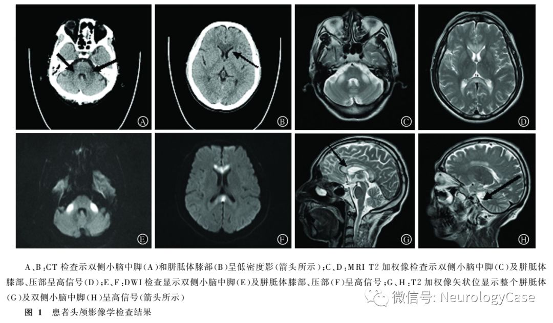 慢性酒精中毒后胼胝体变性,华勒变性一例