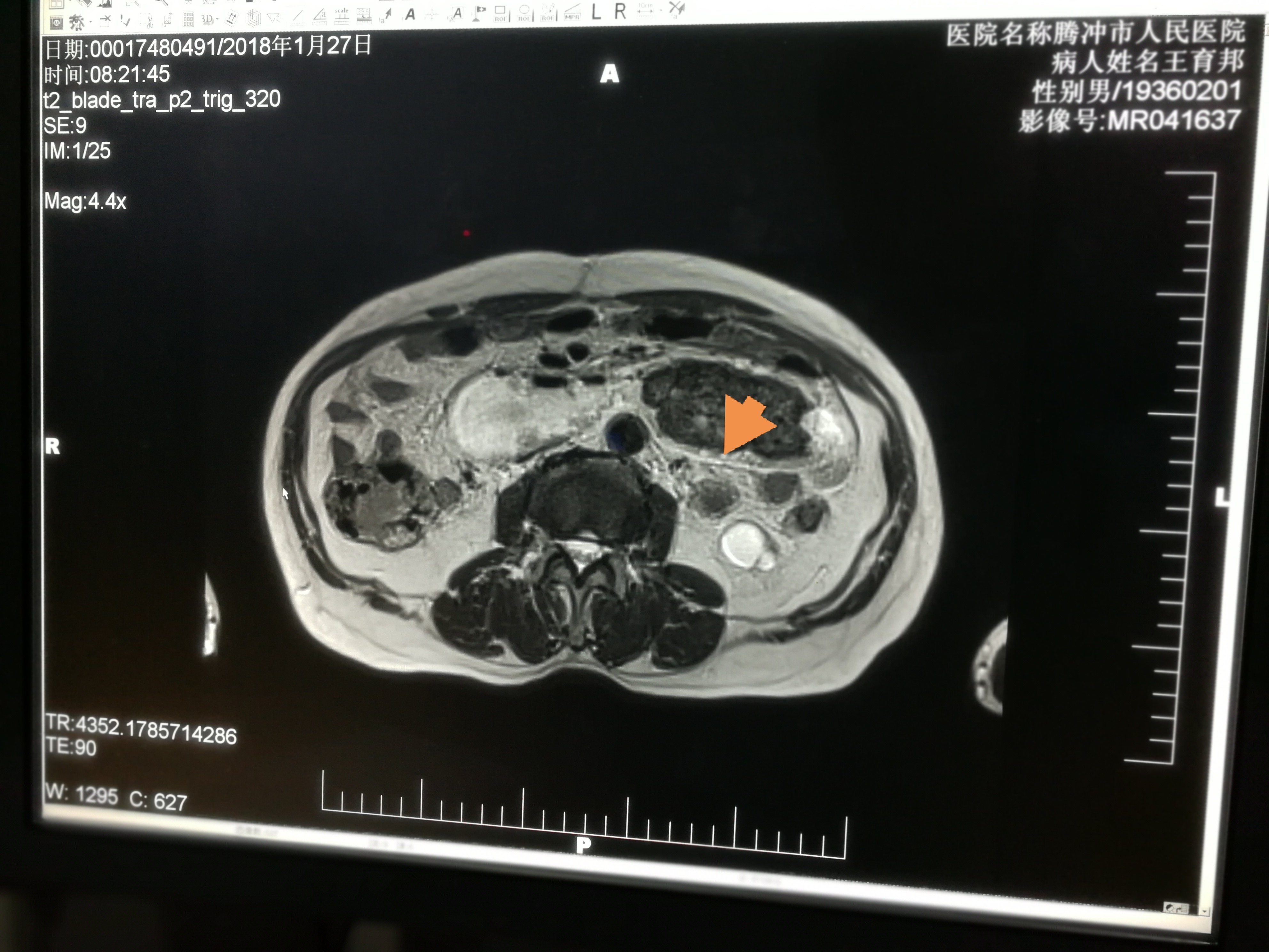 胃癌b超图片图片