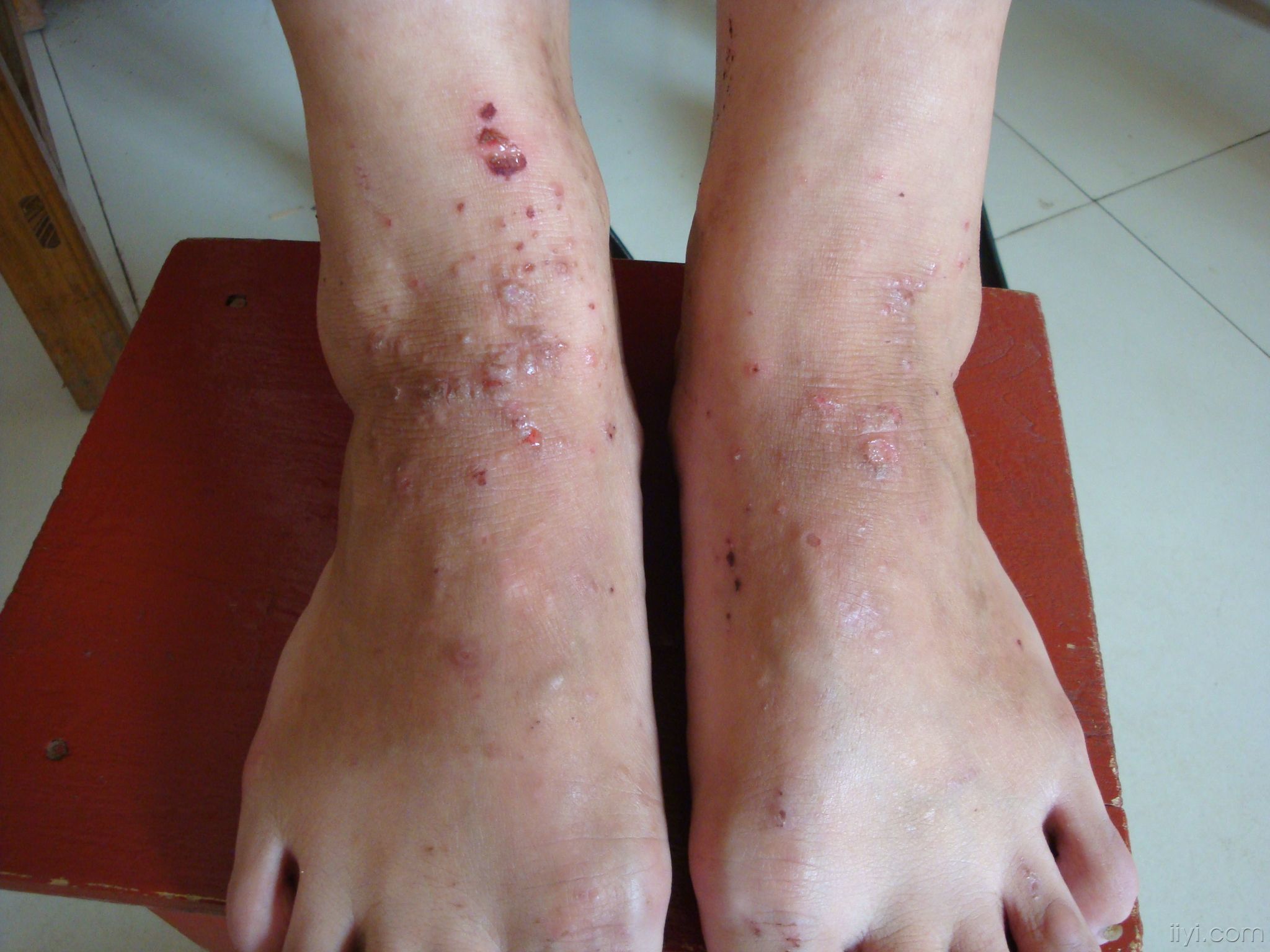 脚上常见的皮肤病图片图片