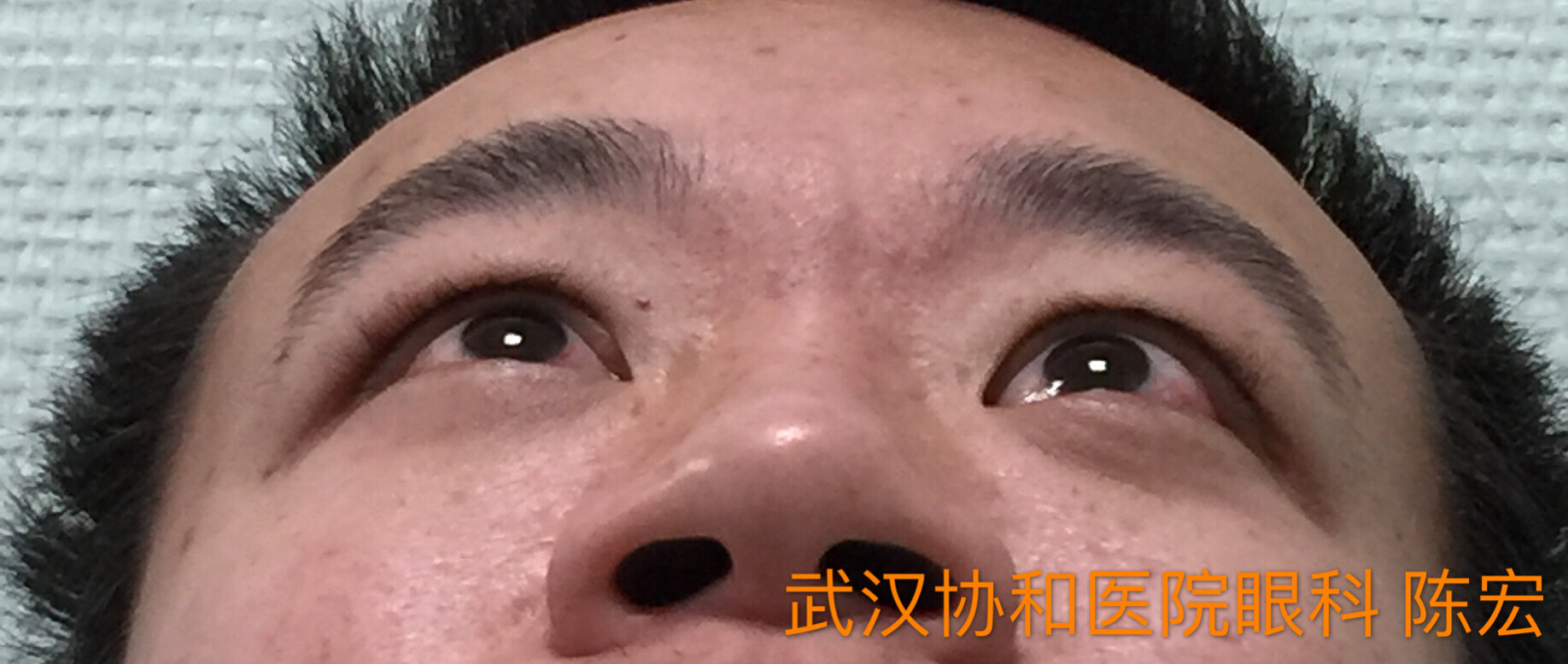 甲狀腺相關眼病眼眶減壓術病例