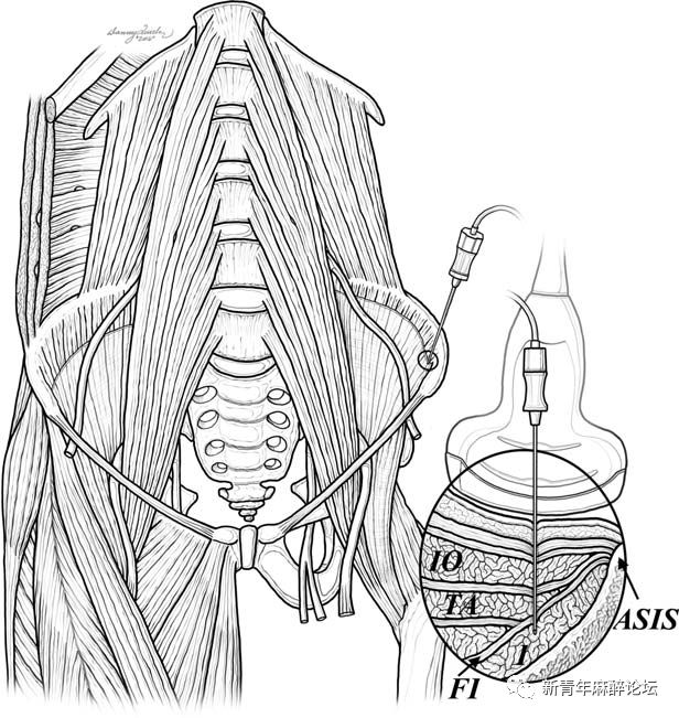 一种新的髂筋膜阻滞方法:腹股沟韧带上髂筋膜阻滞