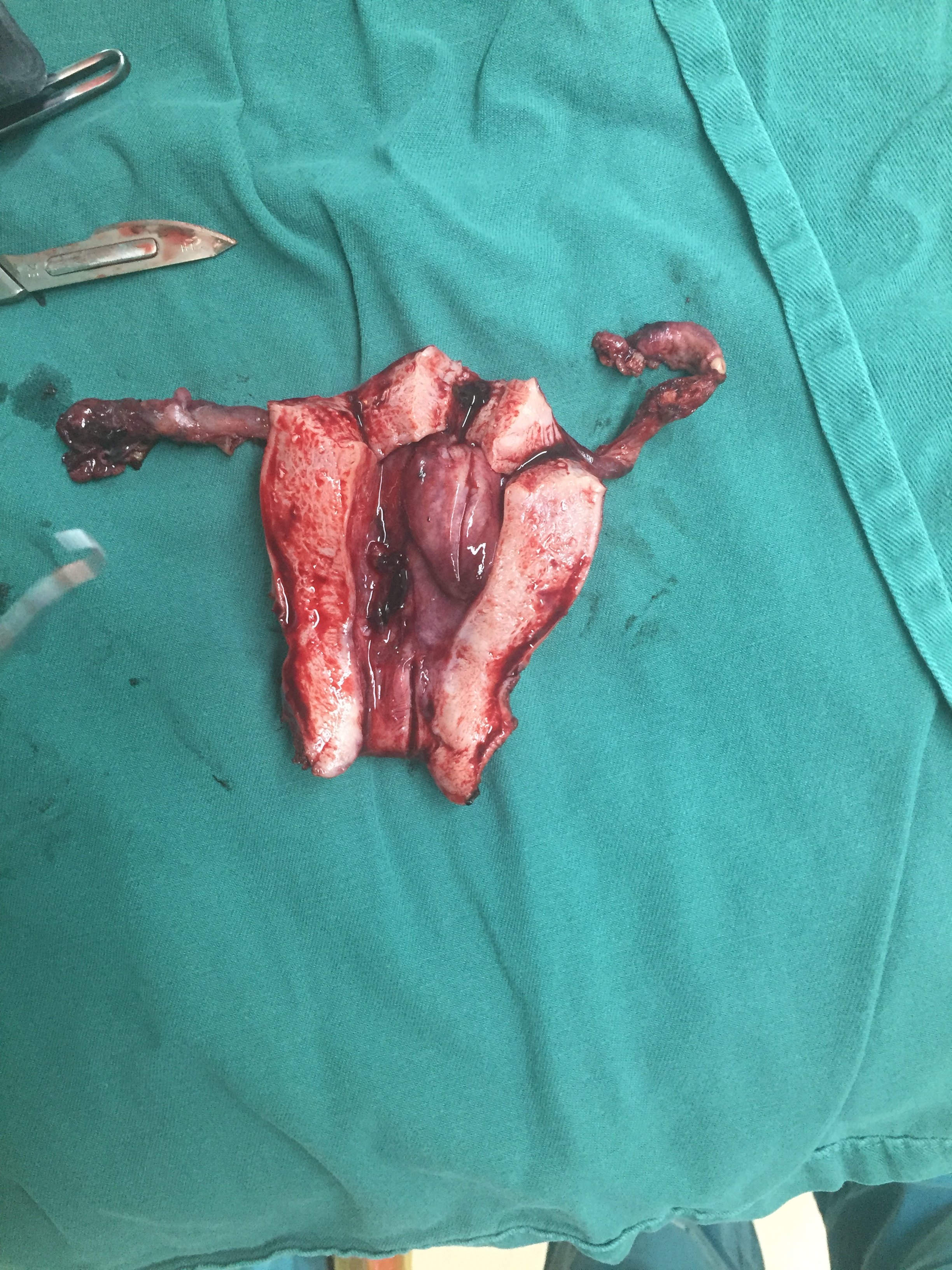 5*2cm大小息肉患者因绝经后反复阴道流血诊刮治疗2次,要求切除子宫