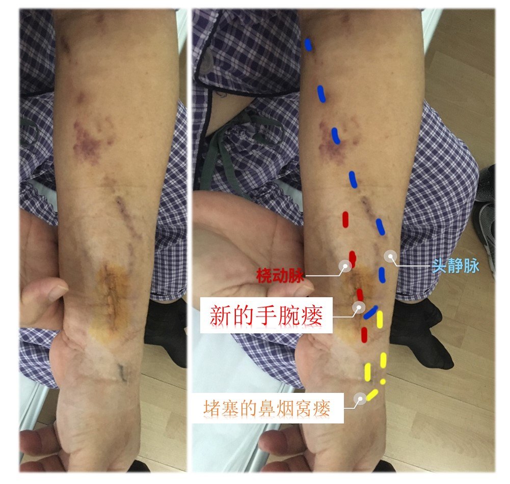 佘大夫谈血液透析通路之7——内瘘可以在哪里做?