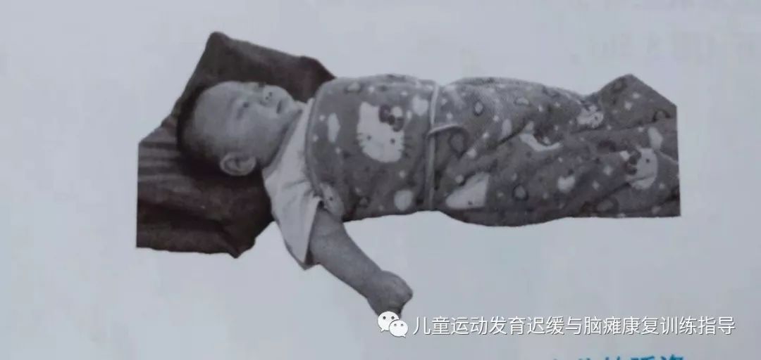 5个脑瘫婴儿睡姿图片图片