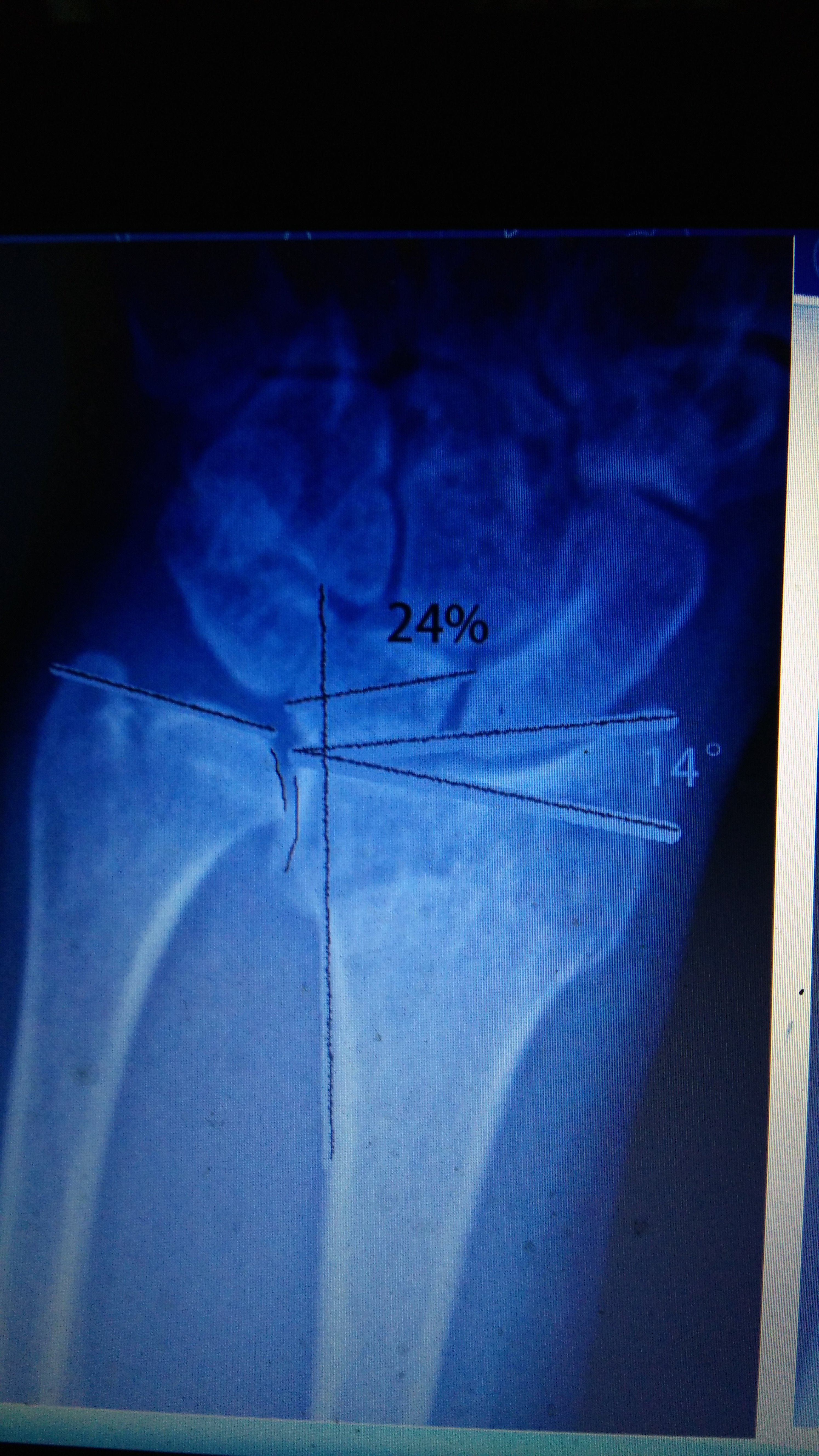 桡骨远端骨折畸形愈合的截骨矫形病例