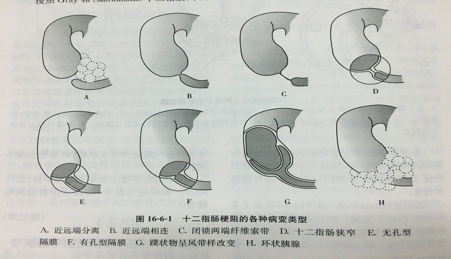 环状胰腺图片